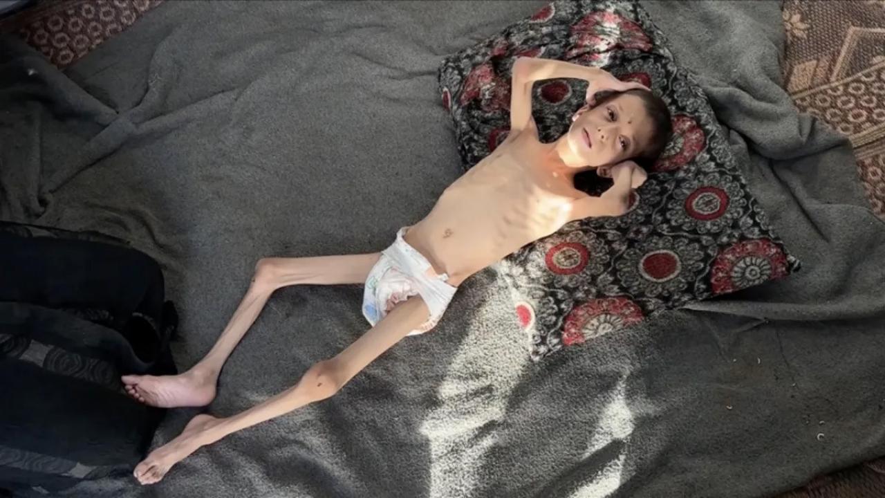 10 yasindaki gazzeli nafiz 4 aylik bebege donustu annesi tasimaya bile korkuyor bQXfHF4e